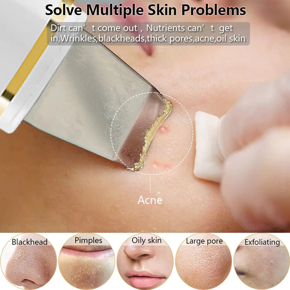 Ultrasonic Skin Scrubber: Facial Cleansing WEM Support (www.WEM.support)